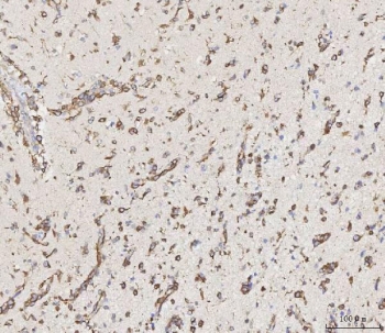 MMP19 Antibody Human Glioma IHC. Immunohistochemistry staining of FFPE human glioma tissue using MMP19 antibody demonstrates widespread cytoplasmic staining within neoplastic cells distributed throughout the tumor parenchyma, consistent with expression of Matrix Metalloproteinase 19 (MMP19). MMP19 is a tissue remodeling protein that regulates extracellular matrix turnover, cellular migration, and interactions between cells and the surrounding microenvironment. The observed staining pattern is consistent with the established role of matrix metalloproteinases in tissue reorganization and extracellular matrix regulation within complex cellular environments. These findings support the utility of MMP19 antibody for studies of tissue remodeling, extracellular matrix dynamics, and tumor-associated cellular behavior. HIER: boil tissue sections in pH8 EDTA for 20 min and allow to cool before testing.
