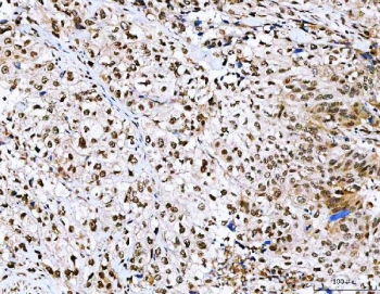IHC staining of FFPE human urothelial carcinoma tissue with NVL antibody. HIER: boil tissue sections in pH8 EDTA for 20 min and allow to cool before testing.