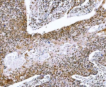 IHC staining of FFPE human esophageal squamous carcinoma tissue with NVL antibody. HIER: boil tissue sections in pH8 EDTA for 20 min and allow to cool before testing.