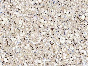 IHC staining of FFPE human adrenal adenoma tissue with NUB1 antibody. HIER: boil tissue sections in pH8 EDTA for 20 min and allow to cool before testing.