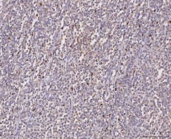 IHC staining of FFPE human arge B-cell lymphoma tissue with MGAT2 antibody. HIER: boil tissue sections in pH8 EDTA for 20 min and allow to cool before testing.
