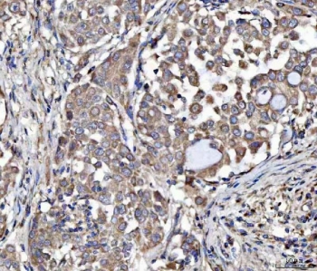 IHC staining of FFPE human lung cancer tissue with MOCS2 antibody. HIER: boil tissue sections in pH8 EDTA for 20 min and allow to cool before testing.
