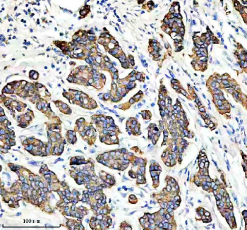 IHC staining of FFPE human breast cancer tissue with Keratin 19 antibody. HIER: boil tissue sections in pH8 EDTA for 20 min and allow to cool before testing.