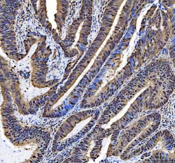 IHC staining of FFPE human colorectal cancer tissue with NCOA5 antibody. HIER: boil tissue sections in pH8 EDTA for 20 min and allow to cool before testing.