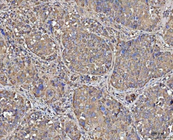 IHC staining of FFPE human liver cancer tissue with MECR antibody. HIER: boil tissue sections in pH8 EDTA for 20 min and allow to cool before testing.