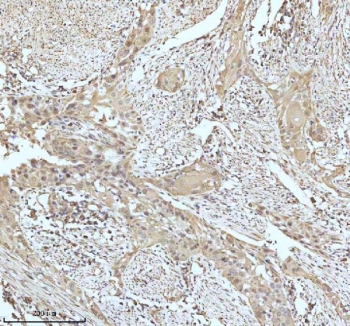 IHC staining of FFPE human urothelial carcinoma tissue with GCLM antibody. HIER: boil tissue sections in pH8 EDTA for 20 min and allow to cool before testing.