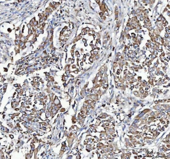 IHC staining of FFPE human lung cancer tissue with MYDGF antibody. HIER: boil tissue sections in pH8 EDTA for 20 min and allow to cool before testing.