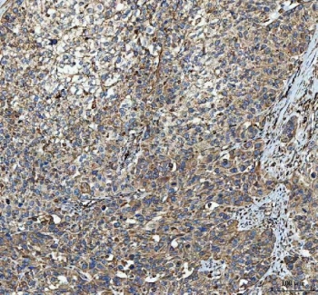 IHC staining of FFPE human bladder urothelial carcinoma tissue with MYDGF antibody. HIER: boil tissue sections in pH8 EDTA for 20 min and allow to cool before testing.