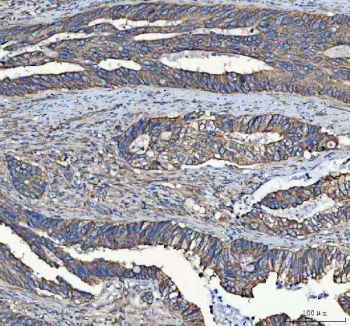 IHC staining of FFPE human colorectal adenocarcinoma tissue with MYDGF antibody. HIER: boil tissue sections in pH8 EDTA for 20 min and allow to cool before testing.