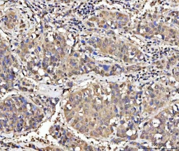 IHC staining of FFPE human liver cancer tissue with MED26 antibody. HIER: boil tissue sections in pH8 EDTA for 20 min and allow to cool before testing.