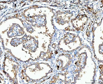 IHC staining of FFPE human thyroid cancer tissue with MGME1 antibody. HIER: boil tissue sections in pH8 EDTA for 20 min and allow to cool before testing.