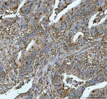 IHC staining of FFPE human colorectal adenocarcinoma tissue with NRMT antibody. HIER: boil tissue sections in pH8 EDTA for 20 min and allow to cool before testing.