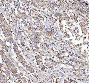 IHC staining of FFPE human lung cancer tissue with NUBPL antibody. HIER: boil tissue sections in pH8 EDTA for 20 min and allow to cool before testing.