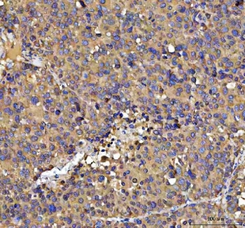 IHC staining of FFPE human liver cancer tissue with NUBPL antibody. HIER: boil tissue sections in pH8 EDTA for 20 min and allow to cool before testing.