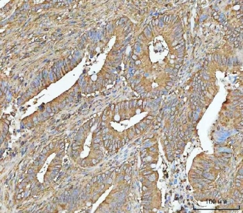 IHC staining of FFPE human colorectal adenocarcinoma tissue with NT5C antibody. HIER: boil tissue sections in pH8 EDTA for 20 min and allow to cool before testing.