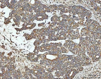 IHC staining of FFPE human ovarian cancer tissue with NT5C antibody. HIER: boil tissue sections in pH8 EDTA for 20 min and allow to cool before testing.