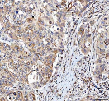 IHC staining of FFPE human bladder urothelial carcinoma tissue with L3MBTL3 antibody. HIER: boil tissue sections in pH8 EDTA for 20 min and allow to cool before testing.