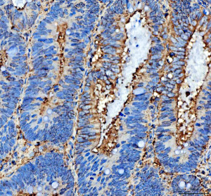 NME6 Antibody Human Colon Cancer IHC. IHC staining of FFPE human colon cancer tissue was performed with NME6 Antibody at 2 ug/ml following heat-induced epitope retrieval in pH 8 EDTA buffer. HRP-conjugated secondary antibody and DAB were used for detection. NME6 staining is observed predominantly in the cytoplasm of tumor cells, with variable staining intensity across the tissue. This NME6 Antibody demonstrates localization of Nucleoside Diphosphate Kinase 6 in human colon cancer tissue.