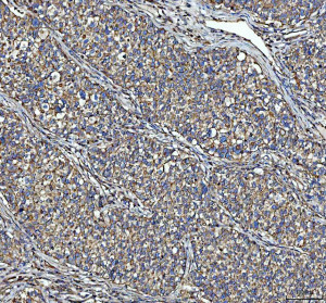 NME6 Antibody Human Lung Cancer IHC. IHC staining of FFPE human lung cancer tissue was performed with NME6 Antibody at 2 ug/ml following heat-induced epitope retrieval in pH 8 EDTA buffer. HRP-conjugated secondary antibody and DAB were used for detection. NME6 staining is observed predominantly in the cytoplasm of tumor cells, with widespread staining across the cancer tissue. This NME6 Antibody demonstrates localization of Nucleoside Diphosphate Kinase 6 in human lung cancer tissue.