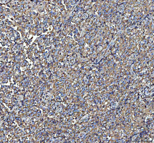 NME6 Antibody Human Spermatocytic Seminoma IHC. IHC staining of FFPE human spermatocytic seminoma testis tissue was performed with NME6 Antibody at 2 ug/ml following heat-induced epitope retrieval in pH 8 EDTA buffer. HRP-conjugated secondary antibody and DAB were used for detection. NME6 staining is observed predominantly in the cytoplasm of tumor cells, with widespread staining throughout the seminoma tissue. This NME6 Antibody demonstrates localization of Nucleoside Diphosphate Kinase 6 in human spermatocytic seminoma tissue.