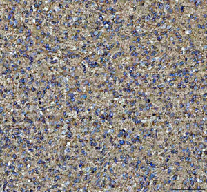 NME6 Antibody Human Glioblastoma IHC. IHC staining of FFPE human glioblastoma tissue was performed with NME6 Antibody at 2 ug/ml following heat-induced epitope retrieval in pH 8 EDTA buffer. HRP-conjugated secondary antibody and DAB were used for detection. NME6 staining is observed predominantly in the cytoplasm of glioblastoma cells, with diffuse staining throughout the tumor tissue. This NME6 Antibody demonstrates localization of Nucleoside Diphosphate Kinase 6 in human glioblastoma tissue.