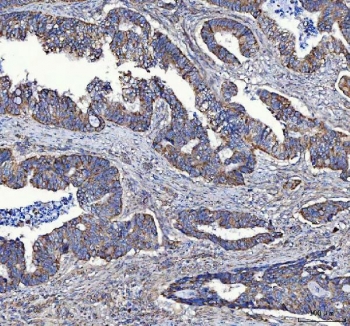 IHC staining of FFPE human colorectal adenocarcinoma tissue with MTCL1 antibody. HIER: boil tissue sections in pH8 EDTA for 20 min and allow to cool before testing.