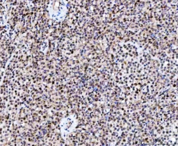 IHC staining of FFPE human large B-cell lymphoma tissue with NUP37 antibody. HIER: boil tissue sections in pH8 EDTA for 20 min and allow to cool before testing.