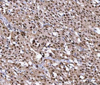 IHC staining of FFPE human bladder urothelial carcinoma tissue with NUP37 antibody. HIER: boil tissue sections in pH8 EDTA for 20 min and allow to cool before testing.
