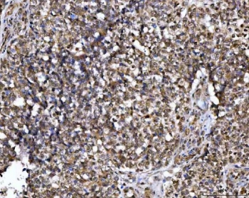 IHC staining of FFPE human ovarian cancer tissue with NUP37 antibody. HIER: boil tissue sections in pH8 EDTA for 20 min and allow to cool before testing.