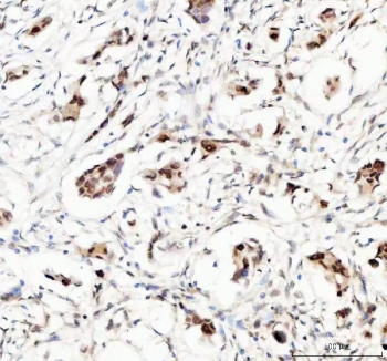 IHC staining of FFPE human breast cancer tissue with Myoneurin antibody. HIER: boil tissue sections in pH8 EDTA for 20 min and allow to cool before testing.