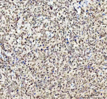 IHC staining of FFPE human cervical squamous carcinoma tissue with Myoneurin antibody. HIER: boil tissue sections in pH8 EDTA for 20 min and allow to cool before testing.