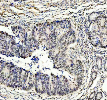 IHC staining of FFPE human colon cancer tissue with PUS7 antibody, HRP-secondary and DAB substrate. HIER: boil tissue sections in pH8 EDTA for 20 min and allow to cool before testing.