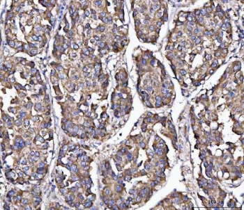 IHC staining of FFPE human liver cancer tissue with MFAP3 antibody. HIER: boil tissue sections in pH8 EDTA for 20 min and allow to cool before testing.