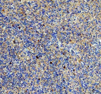 IHC staining of FFPE human glioma tissue with NPTXR antibody. HIER: boil tissue sections in pH8 EDTA for 20 min and allow to cool before testing.