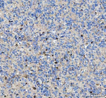 IHC staining of FFPE human glioma tissue with MAP6D1 antibody. HIER: boil tissue sections in pH8 EDTA for 20 min and allow to cool before testing.