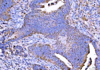 IHC staining of FFPE human colorectal adenocarcinoma tissue with NTN3 antibody. HIER: boil tissue sections in pH8 EDTA for 20 min and allow to cool before testing.