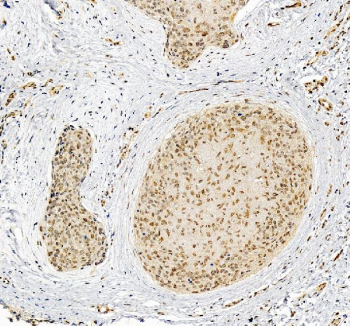 IHC staining of FFPE human skin cancer tissue with FAM55C antibody, HRP-secondary and DAB substrate. HIER: boil tissue sections in pH8 EDTA for 20 min and allow to cool before testing.
