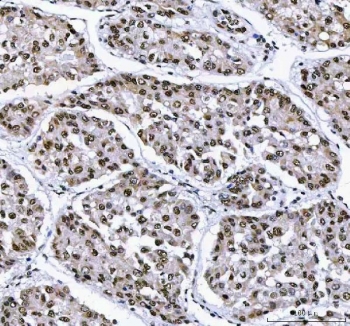IHC staining of FFPE human liver cancer tissue with Aryl Hydrocarbon Receptor Repressor antibody. HIER: boil tissue sections in pH8 EDTA for 20 min and allow to cool before testing.