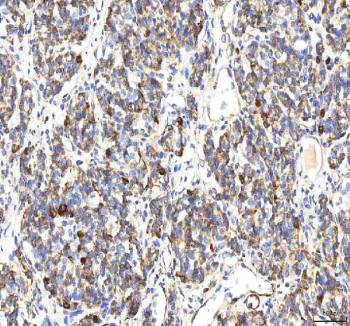 IHC staining of FFPE human lung cancer tissue with PP18 antibody. HIER: boil tissue sections in pH8 EDTA for 20 min and allow to cool before testing.