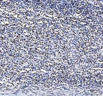 IHC staining of FFPE human large B-cell lymphoma of the colon with LUC7L3 antibody. HIER: boil tissue sections in pH8 EDTA for 20 min and allow to cool before testing.