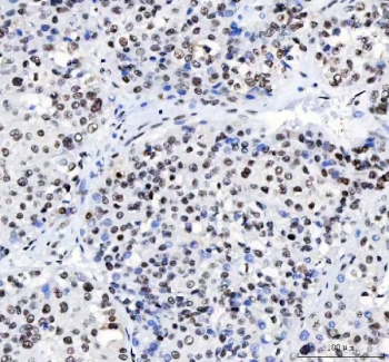 IHC staining of FFPE human liver cancer tissue with LUC7L3 antibody. HIER: boil tissue sections in pH8 EDTA for 20 min and allow to cool before testing.