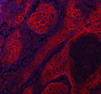 Immunofluorescence analysis of LYPD3 Antibody in human skin cancer tissue. Formalin-fixed, paraffin-embedded human skin cancer sections show strong membranous and peripheral cytoplasmic fluorescence consistent with Ly6/PLAUR domain-containing protein 3 (C4.4A / LYPD3) expression in tumor epithelial cells. LYPD3 antibody signal is visualized in red outlining malignant squamous epithelial cells, while nuclei are counterstained with DAPI (blue). Heat-induced epitope retrieval was performed by steaming tissue sections in pH 8 EDTA buffer for 20 min prior to antibody incubation.