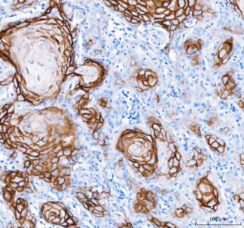 Immunohistochemistry of LYPD3 Antibody in human skin cancer tissue. Formalin-fixed, paraffin-embedded human skin cancer sections demonstrate membranous HRP-DAB brown staining outlining tumor epithelial cells consistent with Ly6/PLAUR domain-containing protein 3 (C4.4A / LYPD3) expression. Positive staining highlights nests of malignant squamous epithelial cells, while surrounding stromal components show minimal signal. Heat-induced epitope retrieval was performed by boiling tissue sections in pH 8 EDTA buffer for 20 min followed by cooling prior to antibody incubation.