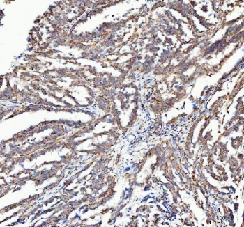 IHC staining of FFPE human ovarian serous adenocarcinoma tissue with ATG7 antibody. HIER: boil tissue sections in pH8 EDTA for 20 min and allow to cool before testing.