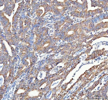 IHC staining of FFPE human colorectal adenocarcinoma tissue with ATG7 antibody. HIER: boil tissue sections in pH8 EDTA for 20 min and allow to cool before testing.