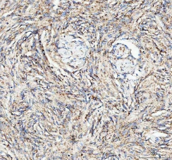 IHC staining of FFPE human meningioma tissue with ATG7 antibody. HIER: boil tissue sections in pH8 EDTA for 20 min and allow to cool before testing.