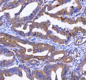IHC staining of FFPE human rectum adenocarcinoma tissue with LYPLA2 antibody. HIER: boil tissue sections in pH8 EDTA for 20 min and allow to cool before testing.