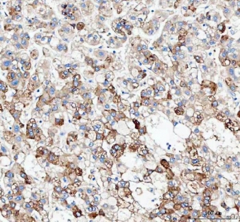 J Chain Antibody Liver Cancer IHC. Immunohistochemistry of FFPE human liver carcinoma tissue using J Chain antibody demonstrates granular HRP-DAB brown cytoplasmic staining in scattered tumor-associated and immune-associated cell populations, consistent with JCHAIN / IGJ expression linked to secretory immunoglobulin production and plasma cell-associated immune activity. HIER: boil tissue sections in pH8 EDTA for 20 min and allow to cool before testing.