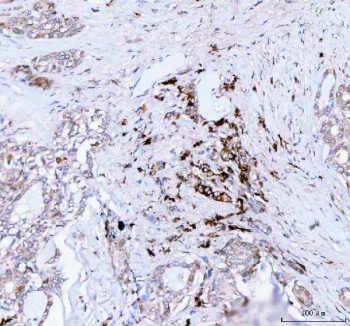 J Chain Antibody Thyroid Cancer IHC. Immunohistochemistry of FFPE human thyroid carcinoma tissue using J Chain antibody shows focal HRP-DAB brown cytoplasmic staining in scattered immune-associated cell populations within the tumor microenvironment, consistent with JCHAIN / IGJ expression in plasma cell-associated secretory immunoglobulin-producing cells. HIER: boil tissue sections in pH8 EDTA for 20 min and allow to cool before testing.