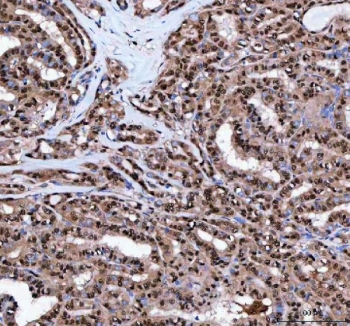 IHC staining of FFPE human thyroid papillary carcinoma tissue with Leukotriene A-4 hydrolase antibody. HIER: boil tissue sections in pH8 EDTA for 20 min and allow to cool before testing.